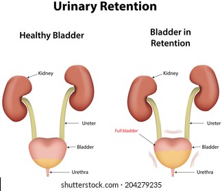 Urinary Retention Hd Stock Images Shutterstock