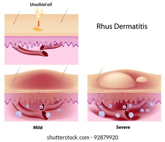 Urushiol Oil Induced Contact Dermatitis