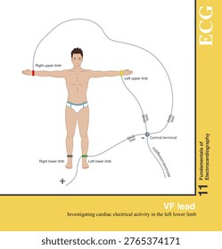 Using the left lower limb as the exploratory electrode and the Wison central terminal as the reference electrode to form the VF lead has been phased out in clinical practice.
