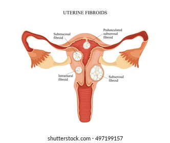 Uterine Fibroid