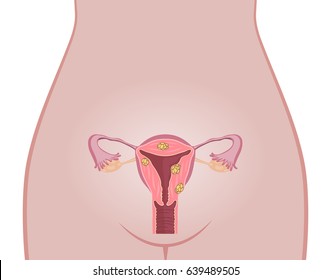 Uterine Fibroids Anatomy. Woman Body