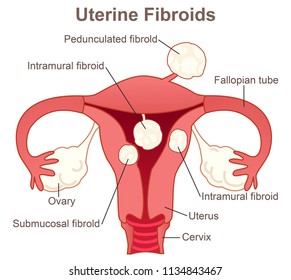 Uterine Fibroids Growth Position