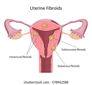 Uterine Fibroids Icon. 