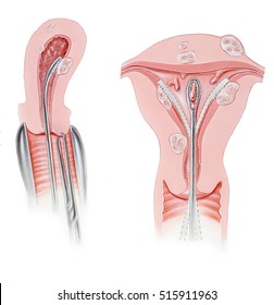 Uterus - Dilation And Curettage  Procedure