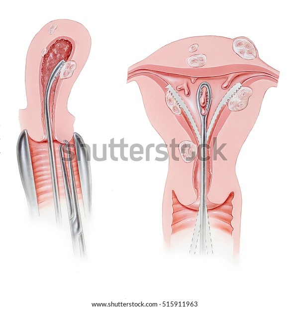 子宮 拡張 掻爬術 のイラスト素材