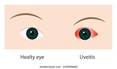 Uveitis Images, Stock Photos & Vectors 