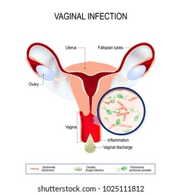 Gardnerella Vagina