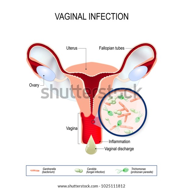 Vaginitis is an inflammation of the vagina. vaginal infection and causative agents of vulvovaginitis: gardnerella (bacterium), candida (fungal), trichomonas (protozoan parasite). Vaginal discharge.