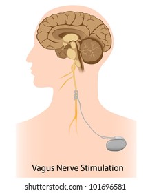 Vagus Nerve Stimulation Therapy