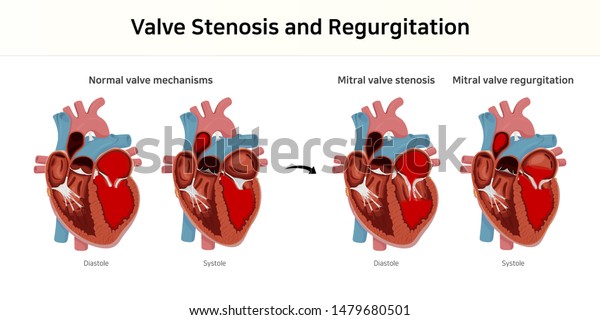 valve\
stenosis and regurgitation. valvular heart\
disease