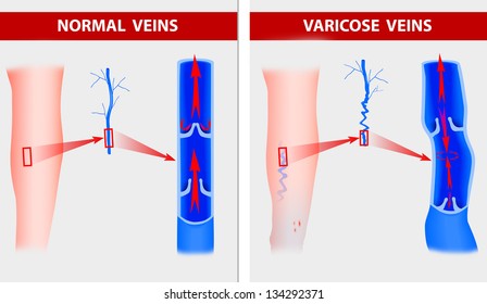 Varicose Veins. The Illustration Shows How A Varicose Vein Forms In A Leg.