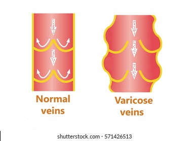 The varicose veins and normal veins