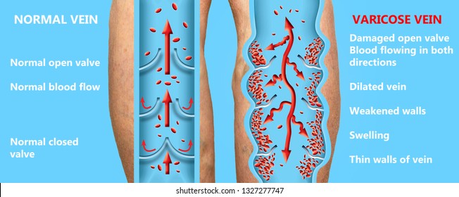 Vein Valve Images Stock Photos Vectors Shutterstock