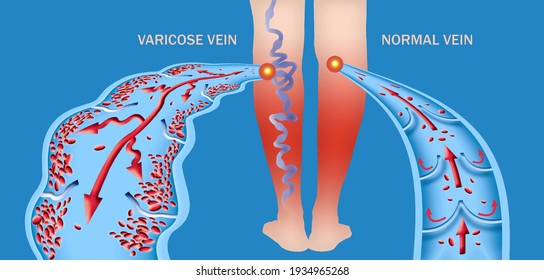 Varicose veins on a female senior legs. The structure of normal and varicose veins. Concept of old senior people, varicose vein and deep vein thrombosis or DVT.