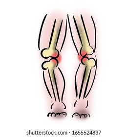 Varus Deformity Of The Knee