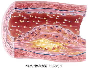 Vascular atherosclerosis showing a cutaway view of accumulated plaque in an afflicted blood vessel.