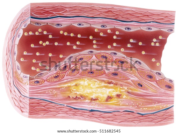 血管アテローム性動脈硬化症は 罹患した血管の蓄積プラークの切断図を示す のイラスト素材