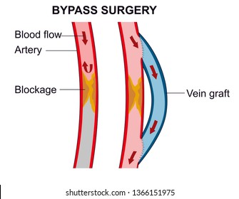 A vascular bypass surgery routes blood to flow around of the blockage area in the artery.