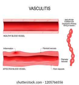 Vasculitis Is Damange Of Blood Vessels By Inflammation. Cross Section Of The Affected, And Healthy Blood Vessel. Aneurysm Formation