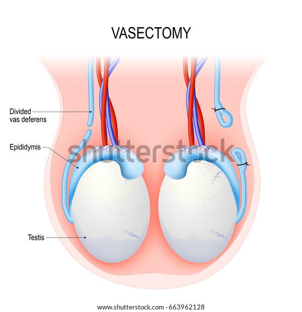 Männern sterilisation bei Vasektomie