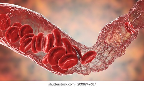 Vasoconstriction, blood clot formation, thromboembolism. Cerebral vasospasm in stroke, coronary artery vasospasm in myocardial infarction, pulmonary embolism. 3D illustration