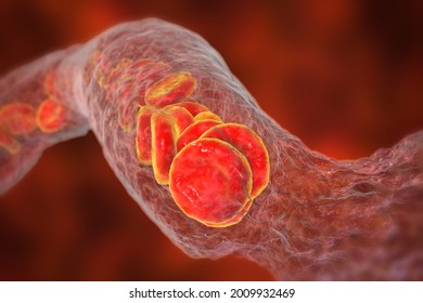 Vasoconstriction, Blood Clot Formation, Thromboembolism. Cerebral Vasospasm In Stroke, Coronary Artery Vasospasm In Myocardial Infarction, Pulmonary Embolism. 3D Illustration. Covid-19 Complication