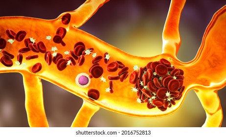 Vasoconstriction, Blood Clot Formation, Thromboembolism. Cerebral Vasospasm In Stroke, Coronary Artery Vasospasm In Myocardial Infarction, Pulmonary Embolism. 3D Illustration. Covid-19 Complication