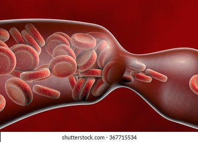 Vasoconstriction, Blood Clot Formation, Thromboembolism. Cerebral Vasospasm In Stroke, Coronary Artery Vasospasm In Myocardial Infarction, Pulmonary Embolism. 3D Illustration. Covid-19 Complication