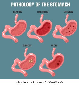 1,371 Pathology Cancer Stomach Images, Stock Photos & Vectors ...