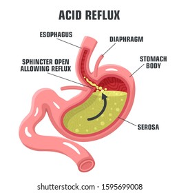 Vector Medical Icon Pathology Of The Stomach. Image Stomach Acid Reflux. Illustration Stomach Gerd In Flat Style