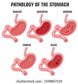 Stomach Ulcer High Res Stock Images Shutterstock