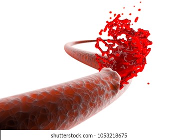 Vein, Artery, Rupture Cut Blood Hemorrhage. 3d Rendering