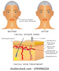 Veins On The Face.  Facial Spider Veins On Nose And Around Nostril Area. Dermis With Varicose Veins.  Laser Veins Removal