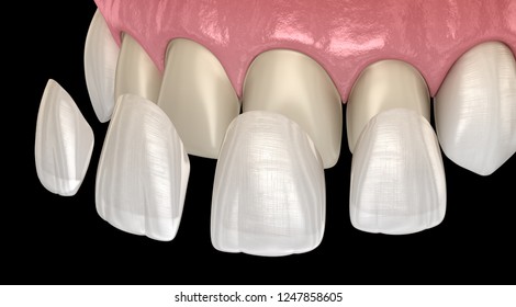 Dental Veneers Hd Stock Images Shutterstock