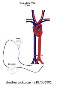 Venoarterial Ecmo Illustration Blood Flow Illustration Stock ...