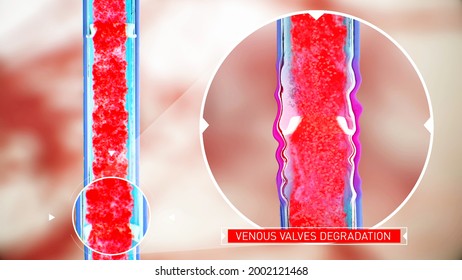 Venous valve dysfunction, degradation of the vein walls, impaired blood flow, Leg vein anatomy, erythrocytes, human anatomy, 3d illustration