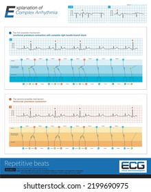 Ventricular And Junctional Premature Contractions Can Activate The Ventricle Again Through The Reentry Mechanism To Form The Complex Arrhythmia Of Repetitive Beats.