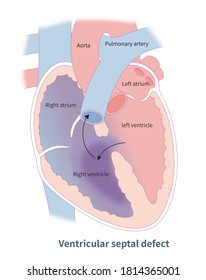 206 Ventricular septal defect Images, Stock Photos & Vectors | Shutterstock