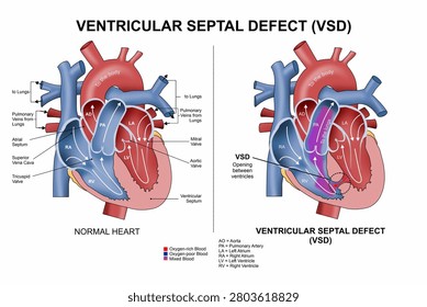 Ventricular Septal Defect (VSD) Heart Illustration