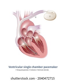 1,118 Ventricular Arrhythmias Images, Stock Photos & Vectors | Shutterstock