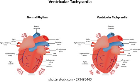 Ventricular Tachycardia Illustration