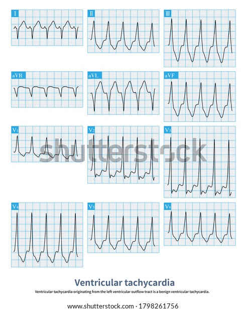 Ventricular Tachycardia Originating Left Ventricular Outflow Stock ...