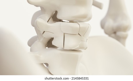 Vertebral Fracture Due To Osteoporosis Of The Spine -- 3d Rendering