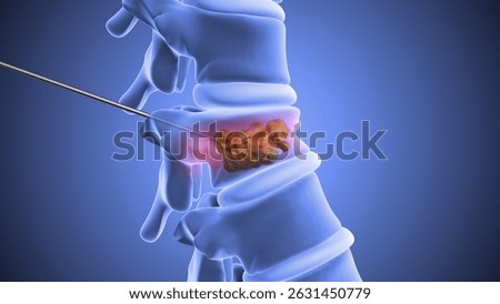 Vertebroplasty or Spinal Vertebrae Stabilization Using Bone Cement 3d illustration