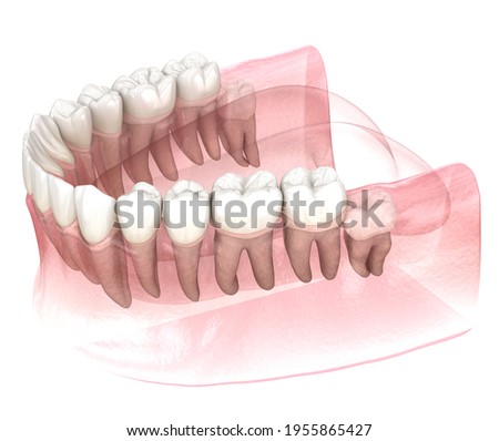 Vertical impaction of Wisdom tooth. Medically accurate tooth 3D illustration
