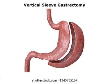 vertical sleeve gastrectomy. Bariatric surgery with reduction of the size of the stomach for weight loss and loss of body weight. 3D rendering
