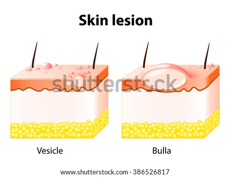 Vesicle Bulla Skin Lesion Stock Illustration 386526817 - Shutterstock