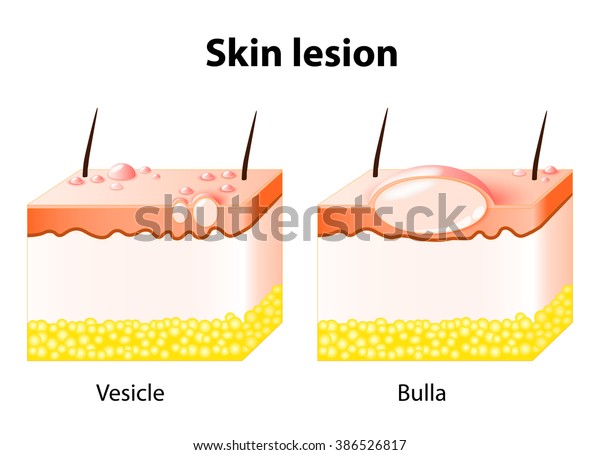 Vesicle Bulla Skin Lesion Stock Illustration 386526817