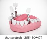 Video shows dental implants inside a half lower jaw model. 3D illustration.