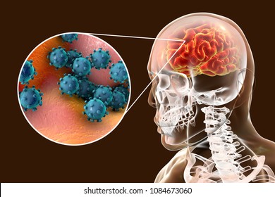 Viral Meningitis And Encephalitis, Medical Concept, 3D Illustration Showing Brain Infection And Close-up View Of Viruses In The Brain